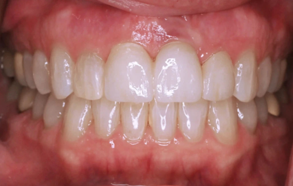 Aging Implant Replacement After A