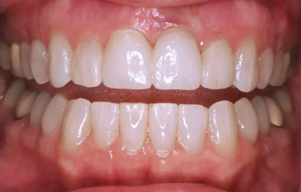 Aging Implant Replacement After B