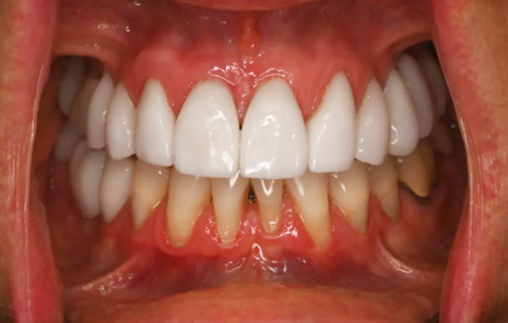 Veneer Replacement After A