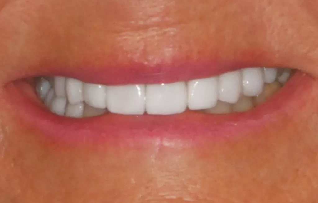 Veneer Replacement After B