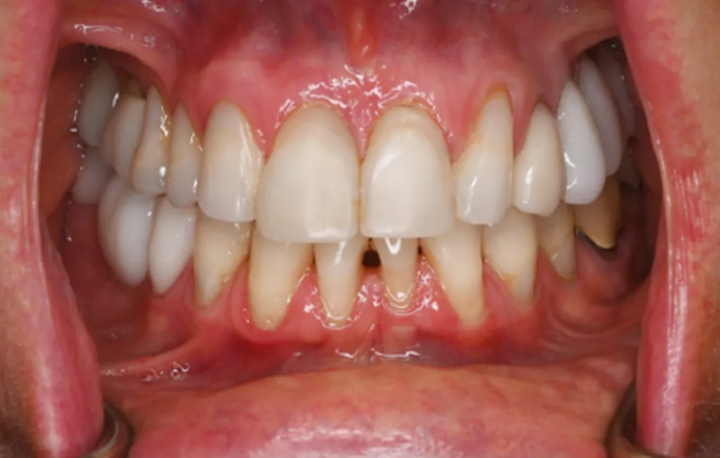 Veneer Replacement Before A