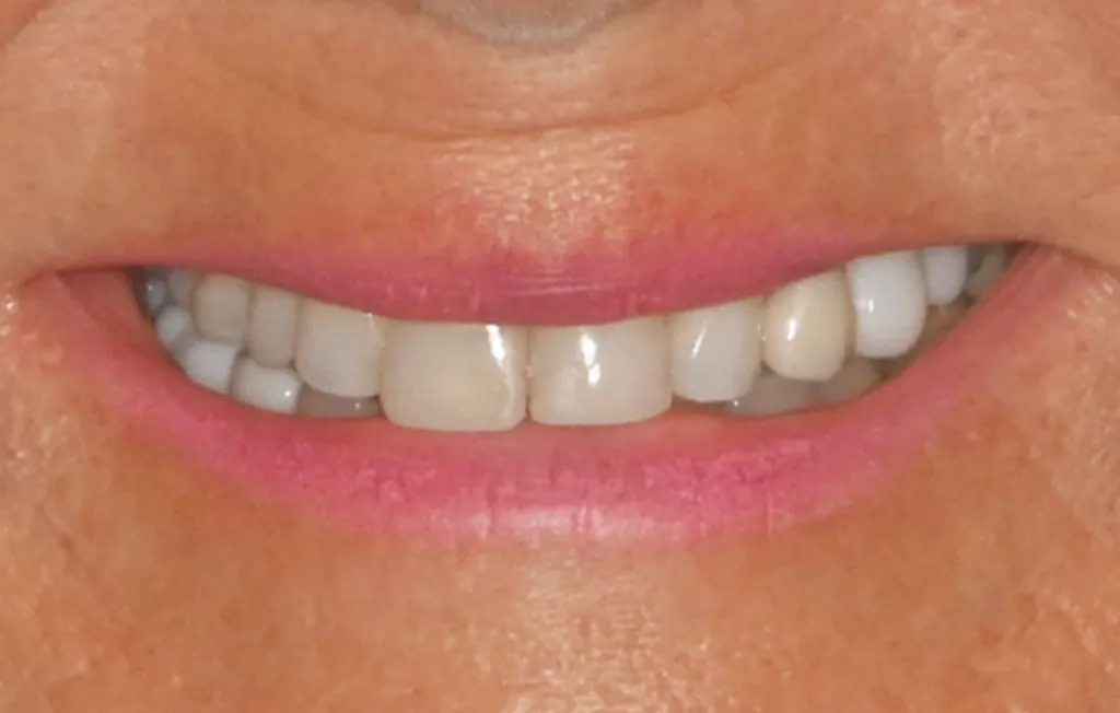 Veneer Replacement Before B